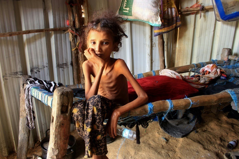 طفلة يمنية تعاني من سوء التغذية في مخيم للنازحين في حجة شمال اليمن (ا ف ب)